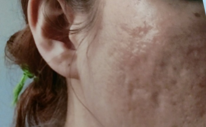 ACNE SCAR UPDATE (1 Year After  FRAXEL LASER). DON’T DO IT!